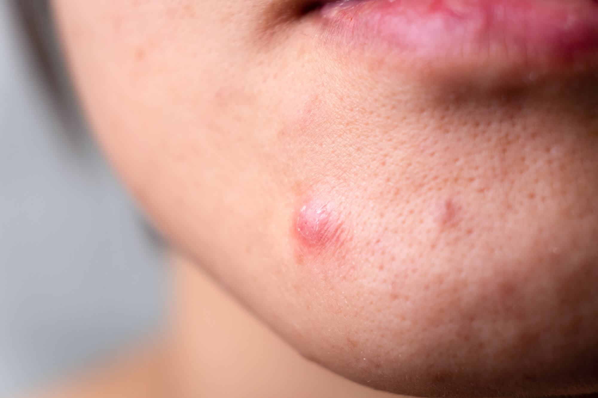 女性經期前下巴會經常生暗瘡