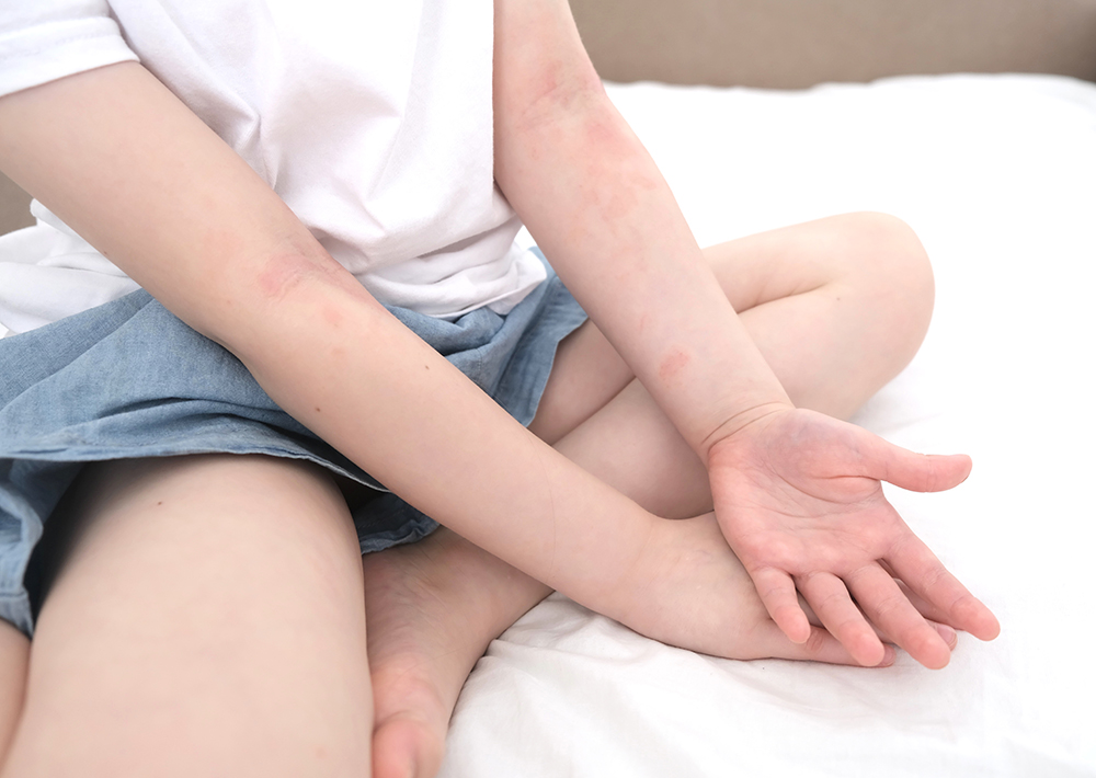 不少兒童也患有濕疹，令家長非常苦惱