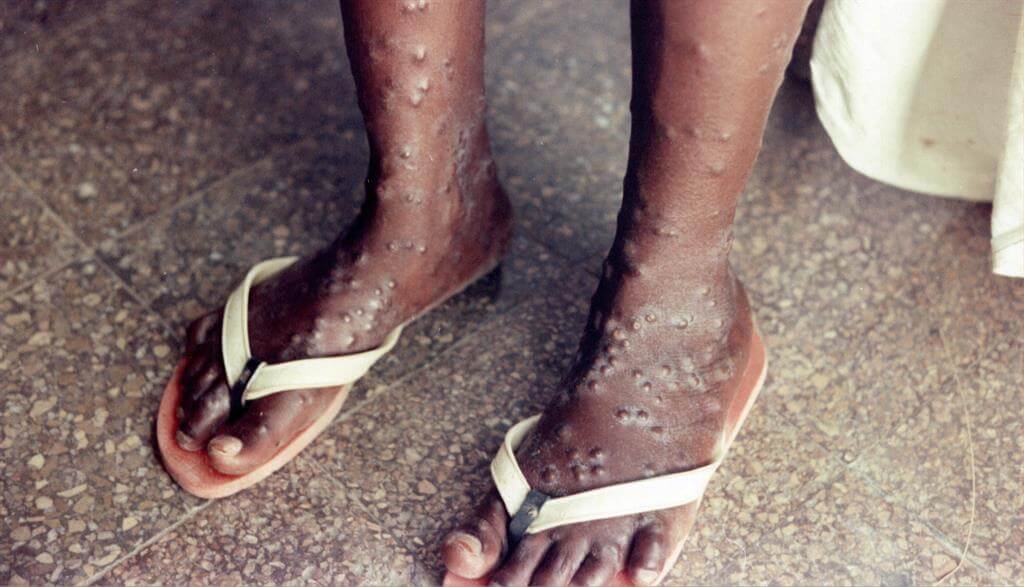 猴痘本來多出現在非洲國家，但今年有向外蔓延的趨勢 （圖片：WHO）