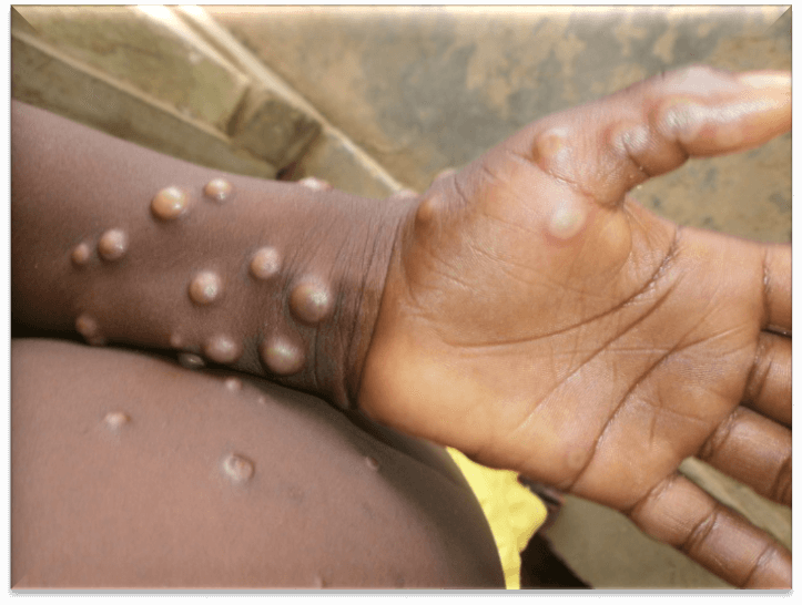 猴痘在發燒的頭幾天，皮膚會出疹。（圖片：WHO）